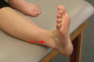 An Instructional Guide: Understanding Ankle Sprain Levels